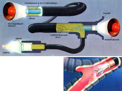 Фиброскоп (вверху) может передать изображение желудка и многих других органов. Линза фокусирует свет от лампы на вход жгута из волоконных световодов. Прошедший по световодам свет освещает полип в желудке. Отраженный от полипа свет фокусируется линзой на торец жгута световодов. Каждый световод в жгуте передает часть полного изображения. Когда свет выходит из наружного конца жгута, изображение полипа восстанавливается и его можно увидеть в окуляр. Фотографии полипов (вставленные на верхнем рисунке) получены с помощью фиброскопа в клинике Мэйо. Фиброскопы часто входят в более сложные приборы, называемые эндоскопами (справа), которые также имеют каналы для введения других приспособлений